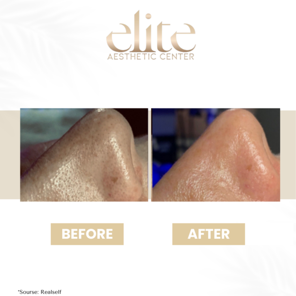 hydrafacial arckezelés