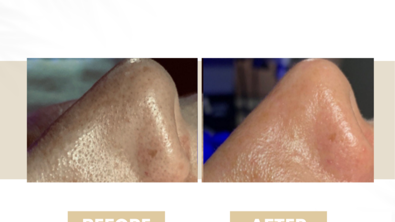 white heads hydrafacial
