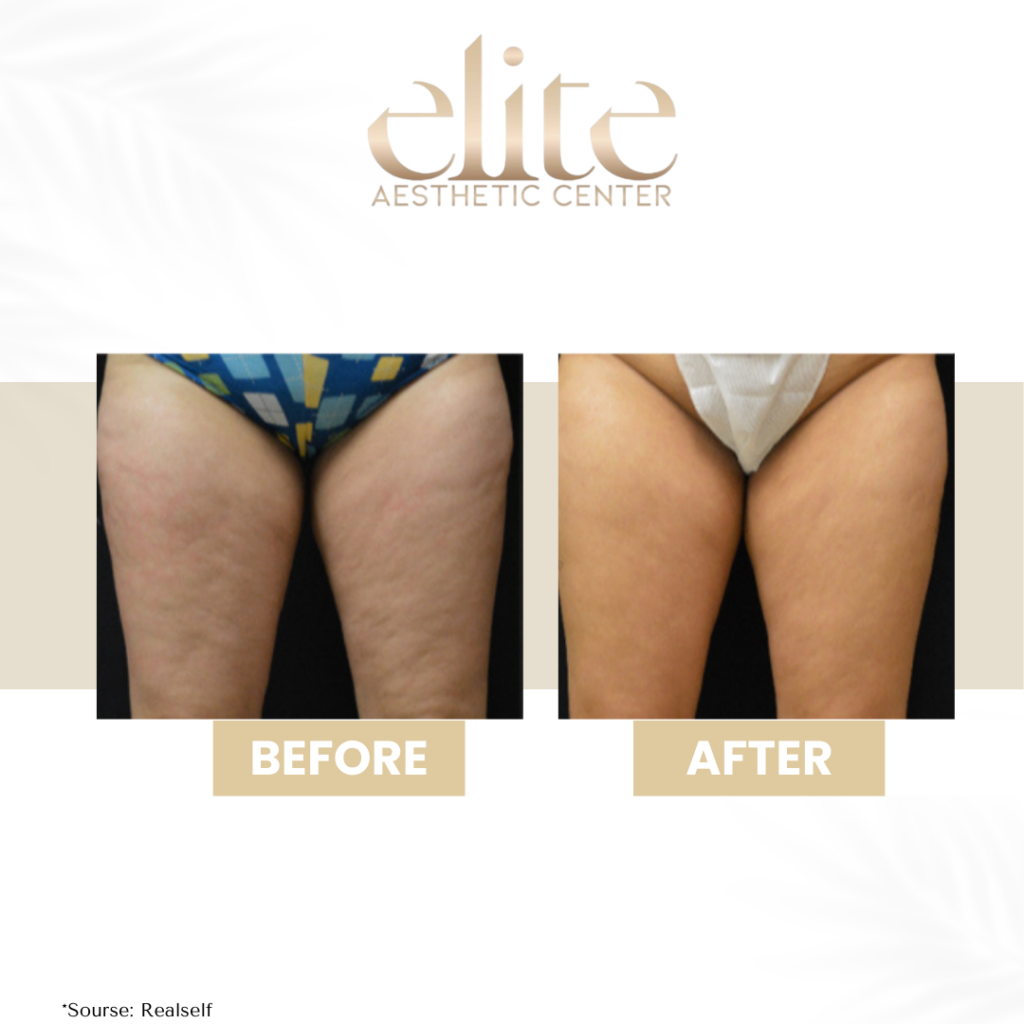 anti cellulite