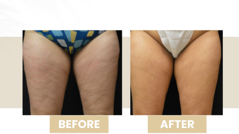 anti cellulite