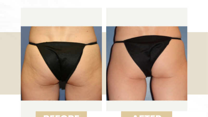 before after venus legacy