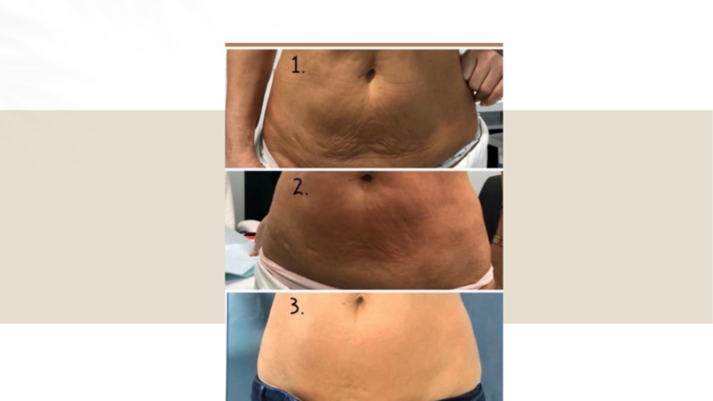 anti cellulite