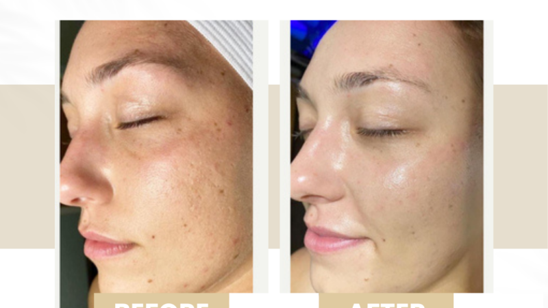 hydrafacial before