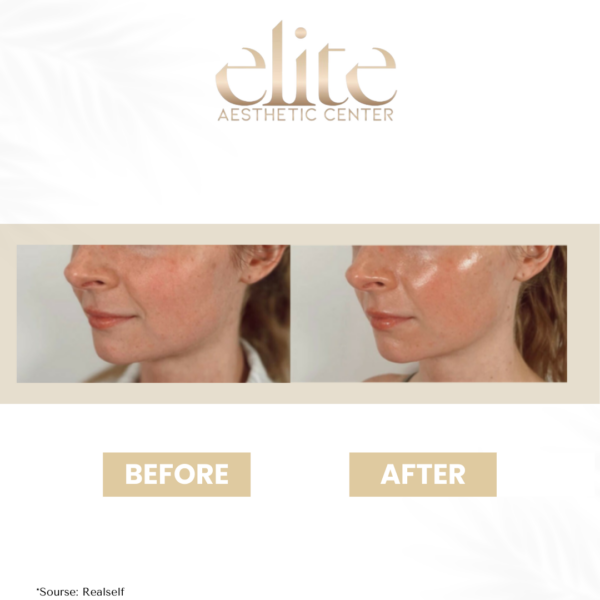 hydra facial