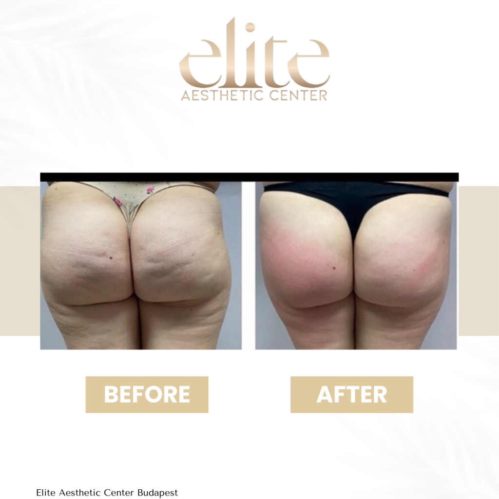 cellulite budapest