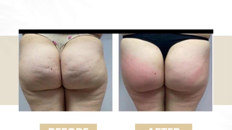 cellulite budapest
