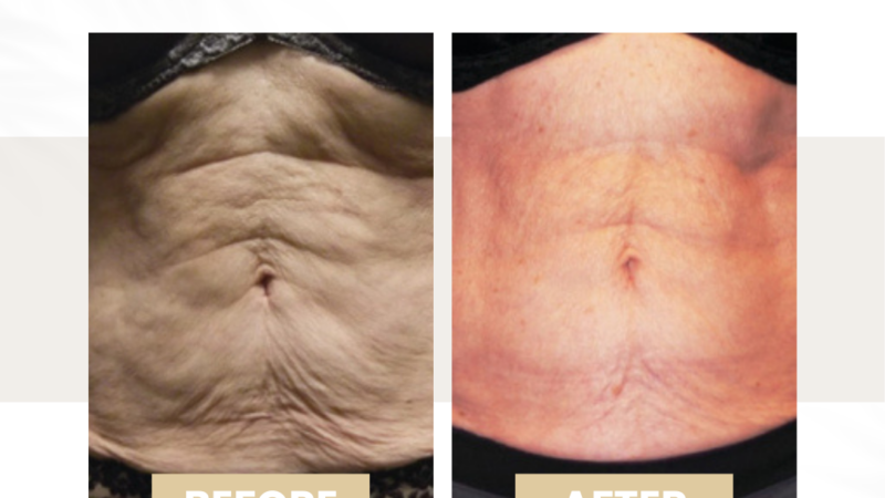 cellulite treatment