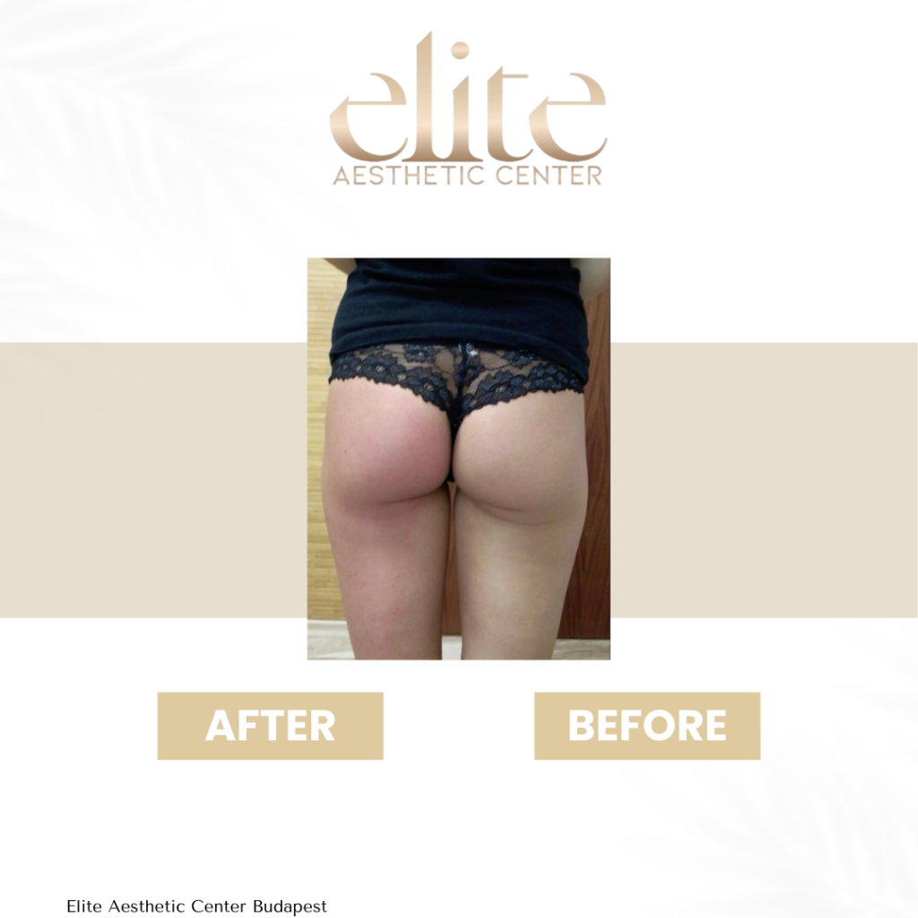 anti cellulite