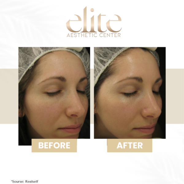 arckezelés hydrafacial
