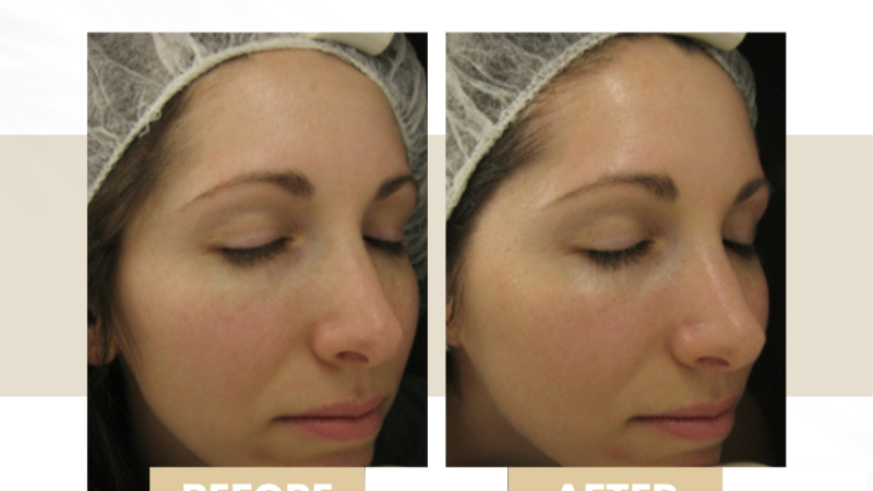 carbon peel hydrafacial