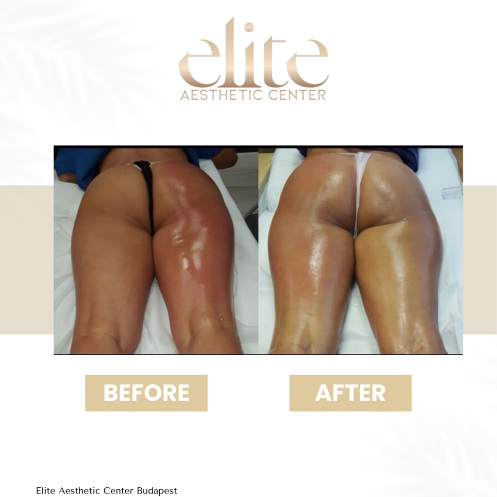 budapest cellulite treatment