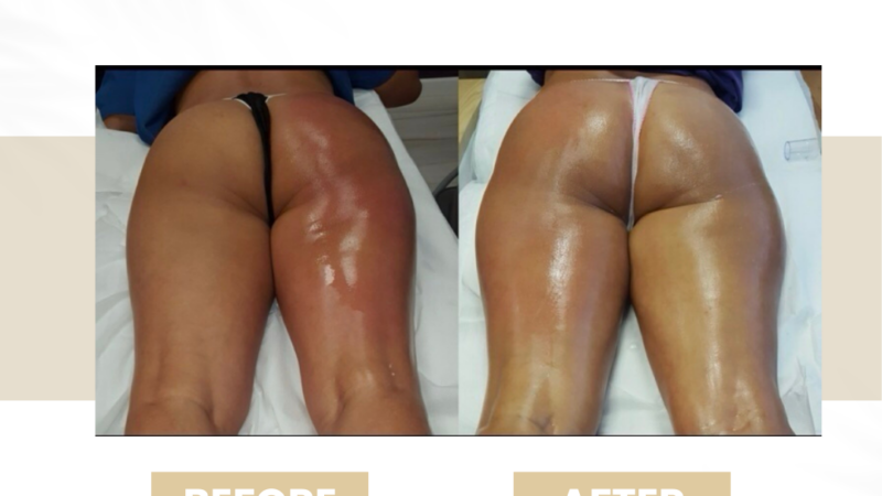 budapest cellulite treatment