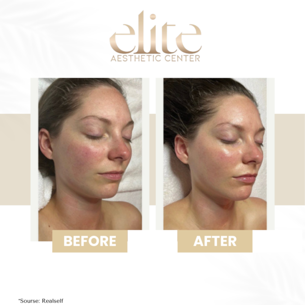hydrafacial arckezelés