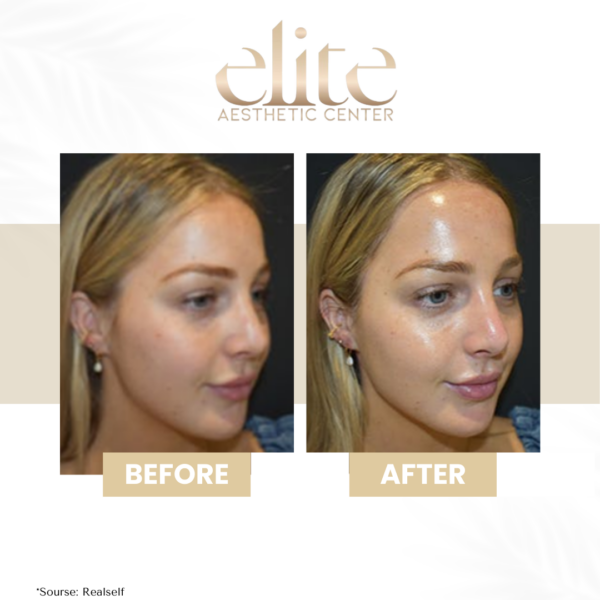Hydrafacial kezelés
