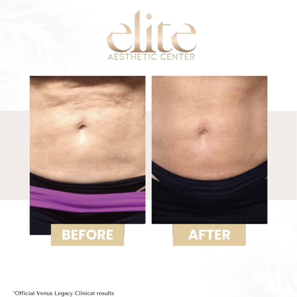 cellulite treatment venus legacy