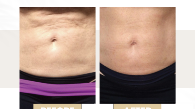 cellulite treatment venus legacy