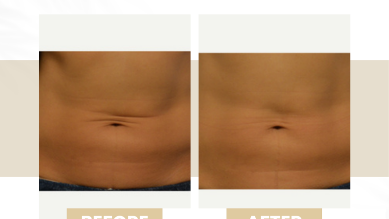 cellulite treatment budapest