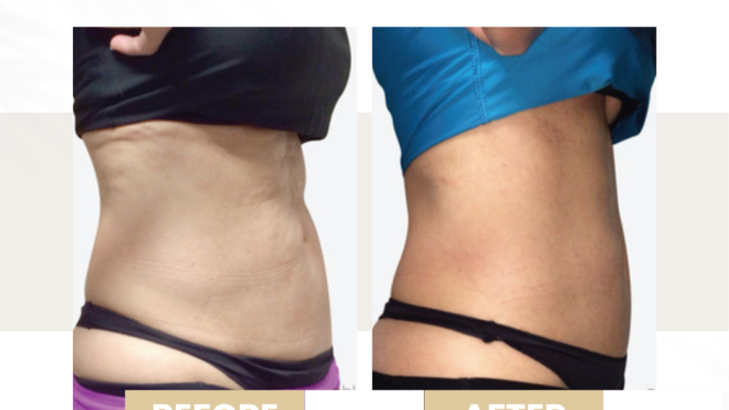 before and after venus legacy