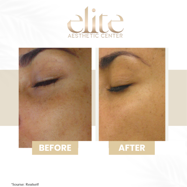 arckezelés hydrafacial