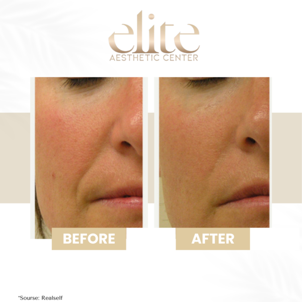 hydrafacial