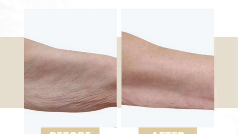 venus legacy before after