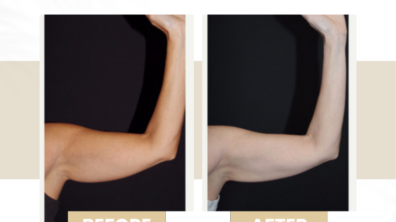 cellulite treatment