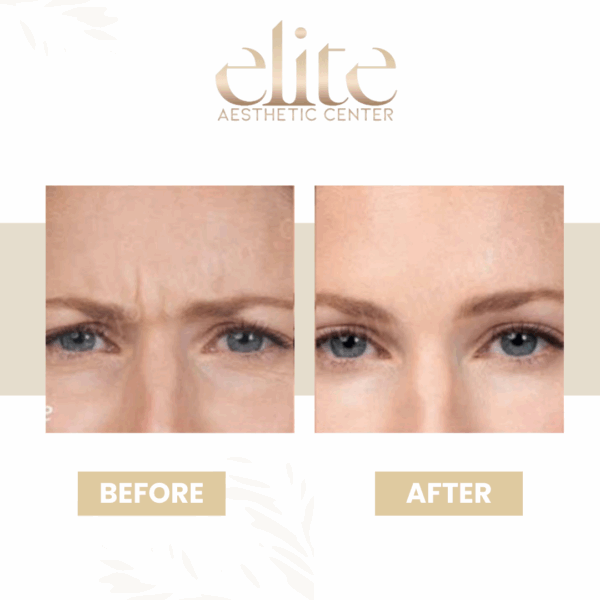 Botox kezelés budapest