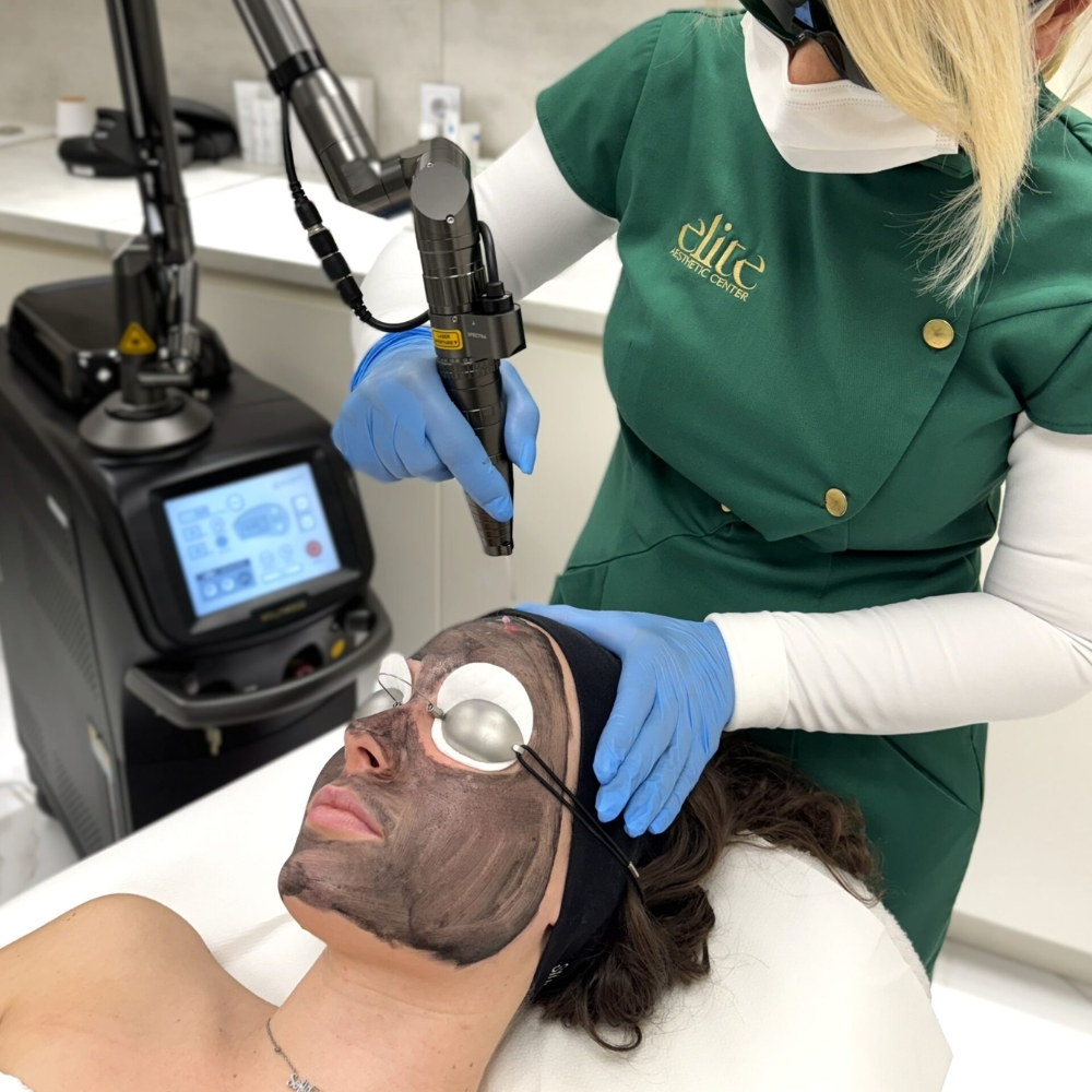 Hollywood Carbon Peel