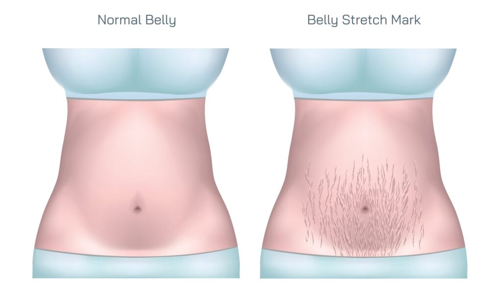 Belly_Stretch_Mark