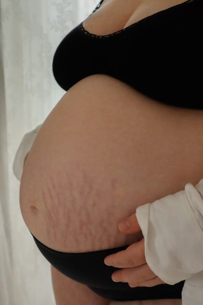 Strea belly